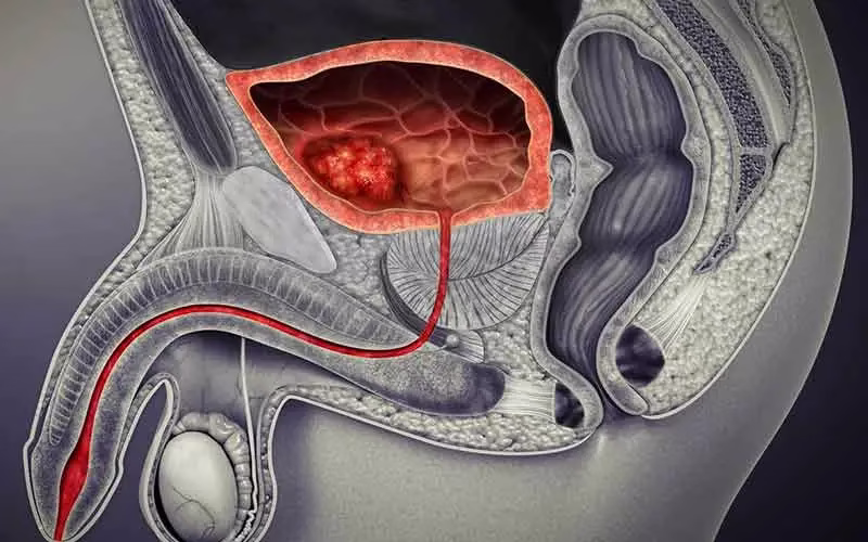 Which-doctor-should-we-see-for-prostate-treatment