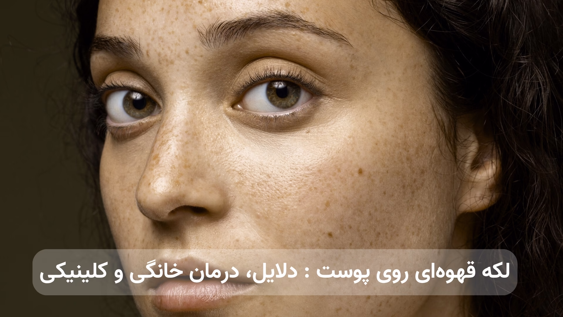 لکه قهوهای روی پوست : دلایل، درمان خانگی و کلینیکی leke-ghahvei-rooye-poost