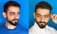 خواص روغن هسته انار برای پوست : ۱۰ فایده + ۱۵ عکس قبل/بعد انتخاب عینک مناسب برای فرم صورت