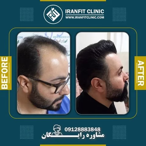 نمونه-کاشت-مو-قبل-و-بعد